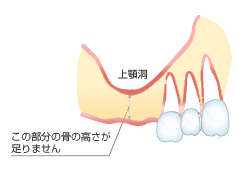 サイナスリフト