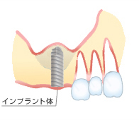 サイナスリフト