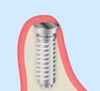 GBR法（骨再生誘導法、Guided Bone Regeneration）