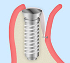 GBR法（骨再生誘導法、Guided Bone Regeneration）