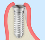 GBR法（骨再生誘導法、Guided Bone Regeneration）