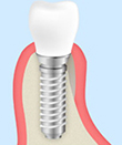 GBR法（骨再生誘導法、Guided Bone Regeneration）