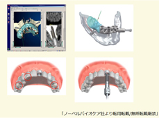 インプラントシミュレーションソフト